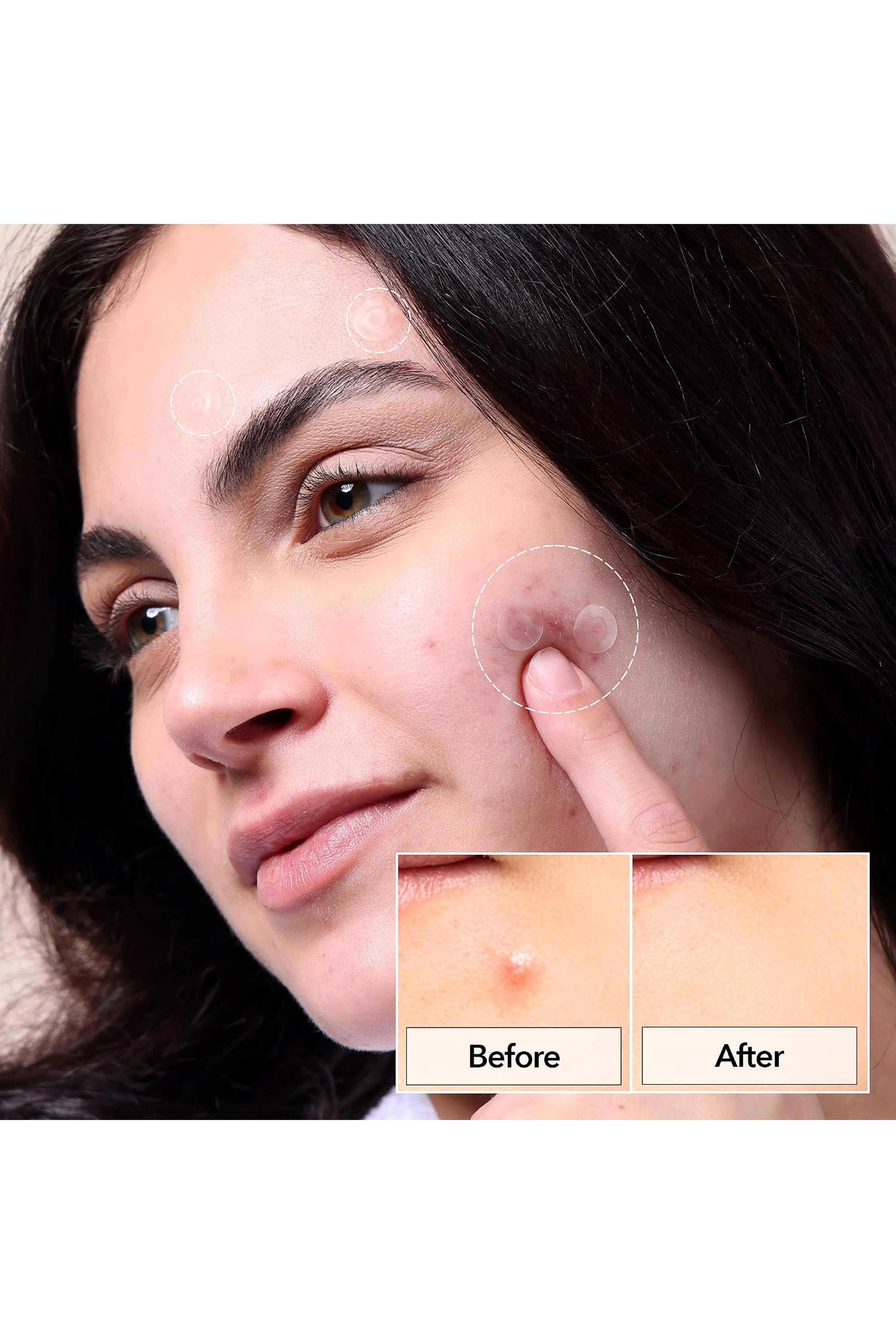 FREEGO PIMPLE & PORE SPOT PATCH