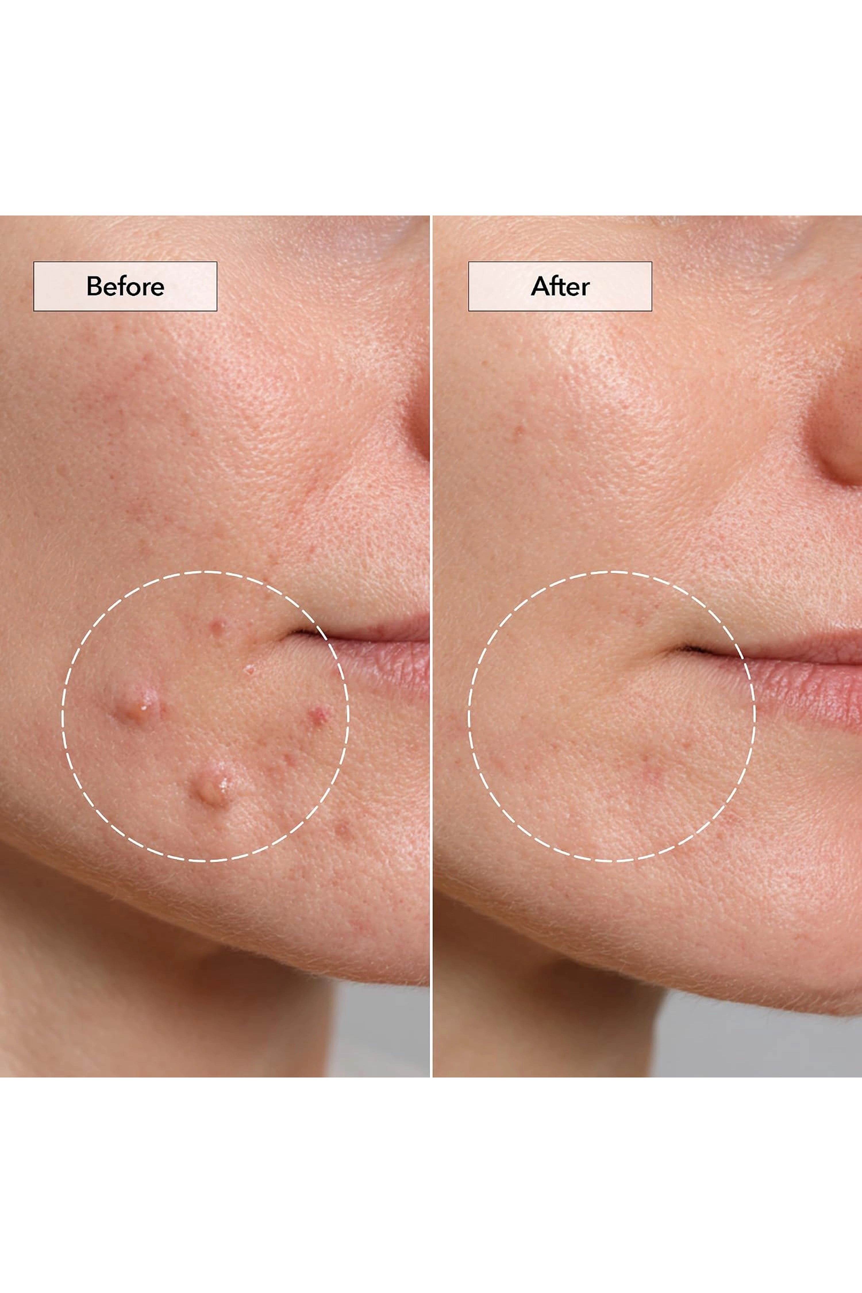 FREEGO PIMPLE & PORE SPOT PATCH