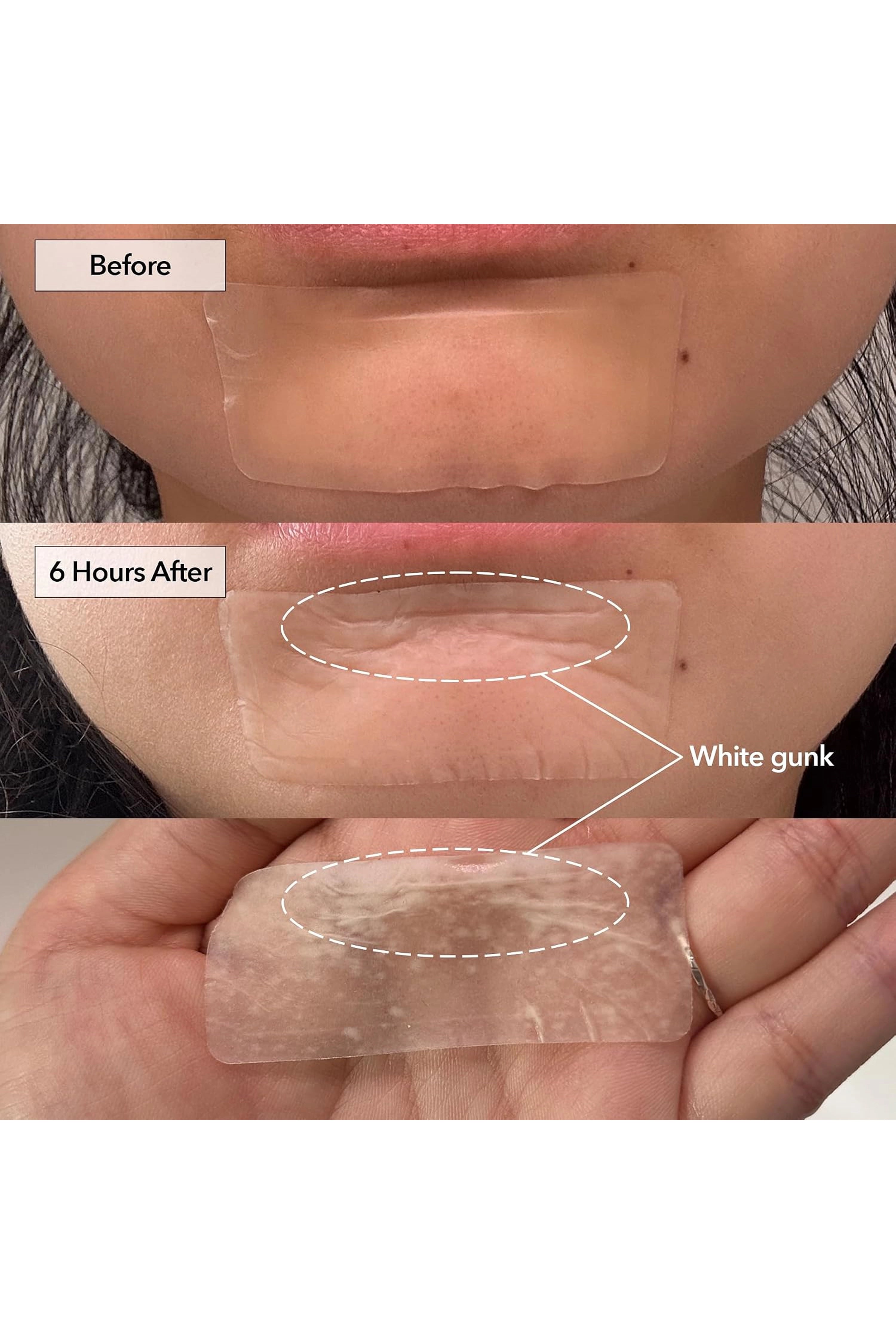 FREEGO PIMPLE & PORE SPOT PATCH