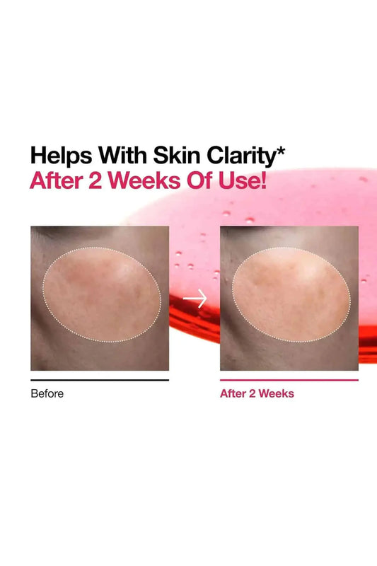 Clinical results showing significant improvement in skin clarity after 2 weeks, making it the best serum for acne scars and dark spots.