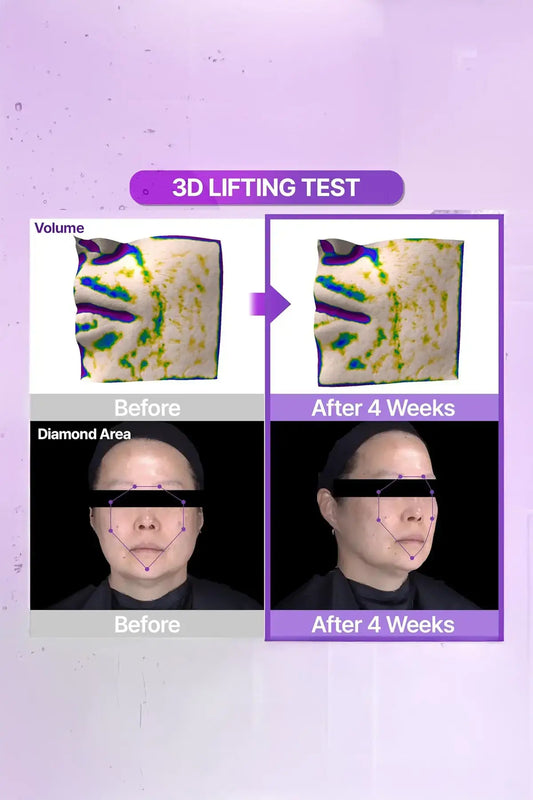 Bioheal BOH 3D Lifting Ampoule Clinical Results - Best Korean Lifting Product, Anti Wrinkle Serum 3D Lifting Test Before and After 4 Weeks, Volume and Diamond Area Improvement, Face Contouring Results