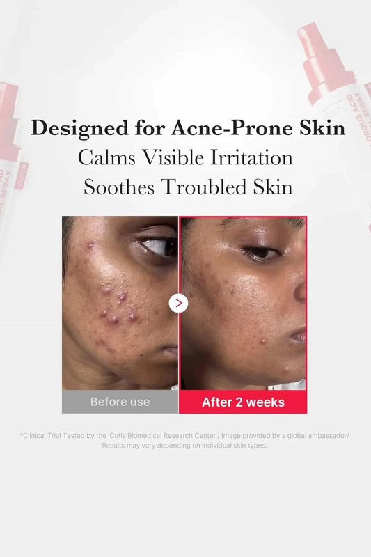 Before and after results showing calmed irritation on acne-prone skin using this gentle sensitive skin toner mist.